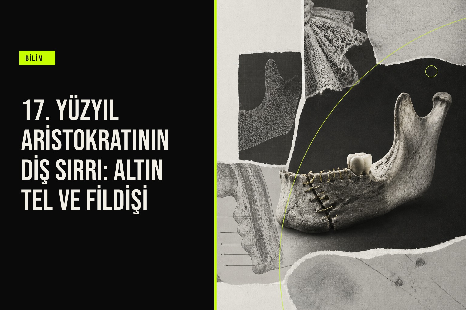 17. yüzyıl Fransız aristokratı Anne d’Alègre’nin çenesinde bulunan altın tel ve fildişi diş protezinin 3B tarama görüntüsü.