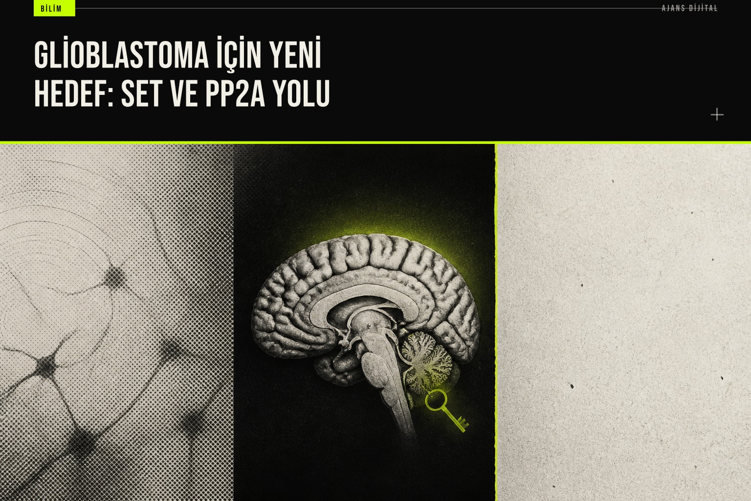 Glioblastoma hücrelerinde SET proteini inhibisyonunun tümör büyümesini durdurup radyoterapi duyarlılığını artırdığını gösteren laboratuvar bulguları.