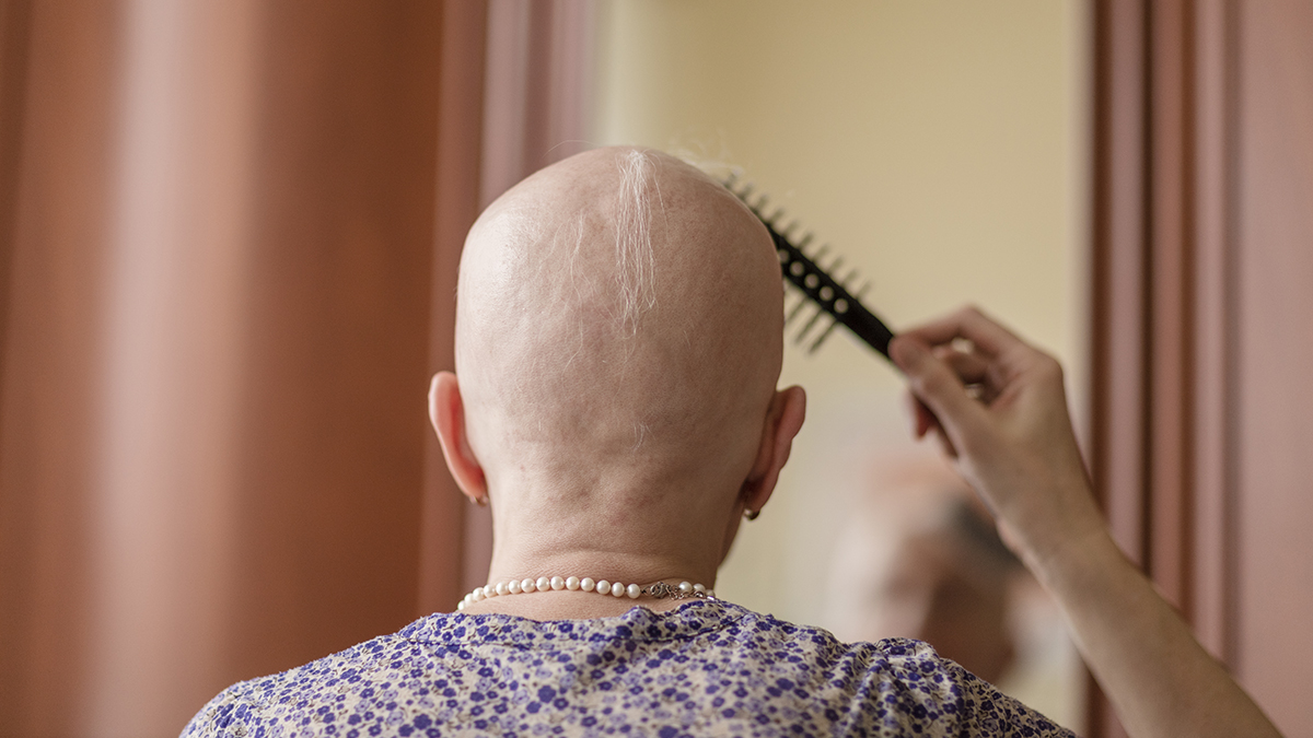 Romatizma ilacı upadasitinib, şiddetli saç dökülmesinde yüzde 100'e kadar sonuç verdi