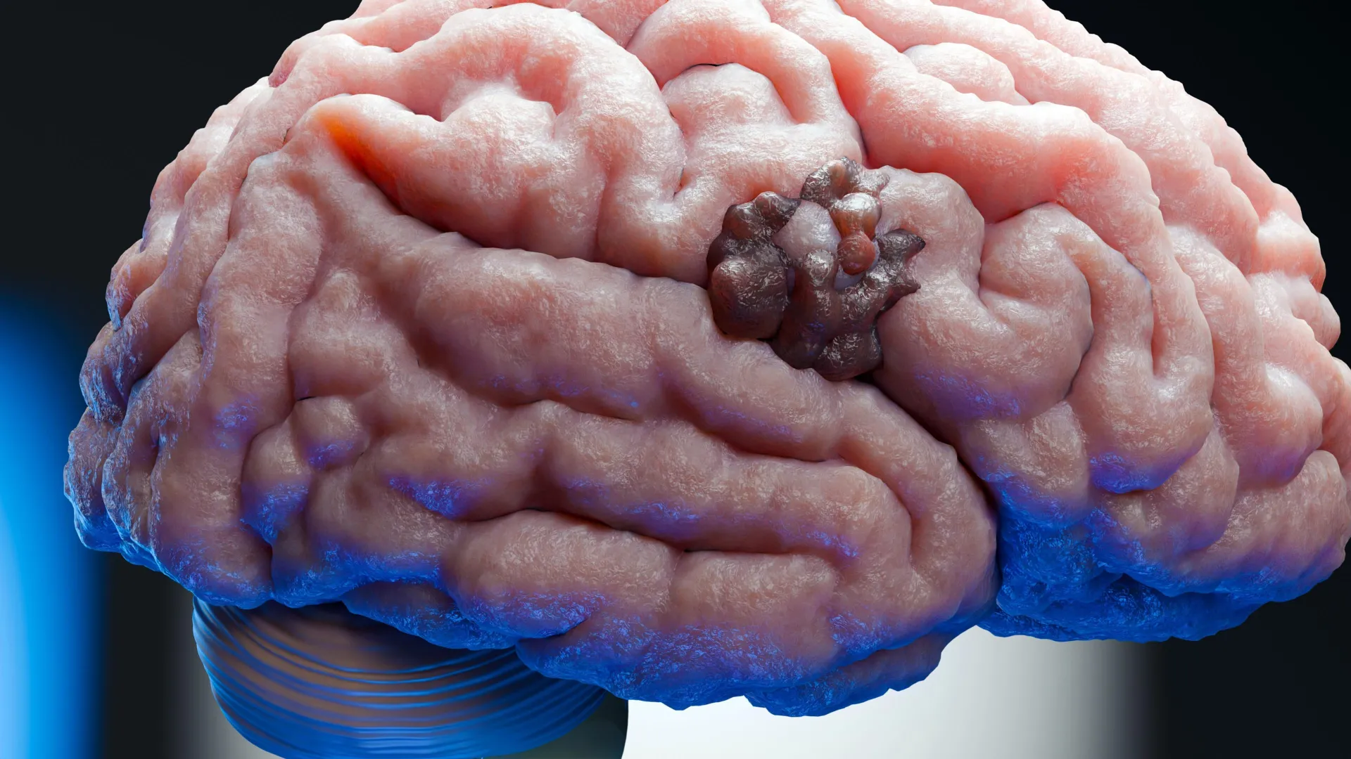 Glioblastoma'da SET proteini hedef alınıyor