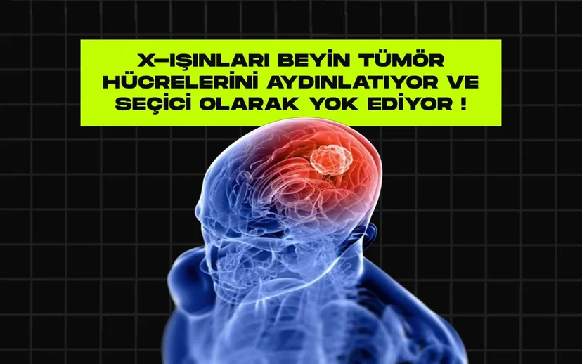 Beyin tumoru